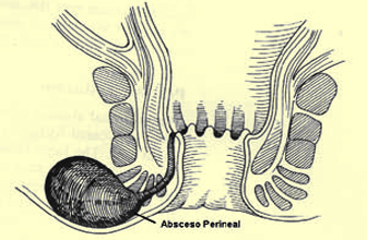 absceso