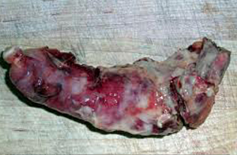 apendicitis