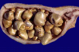coleliatisis
