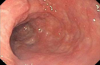 colitis