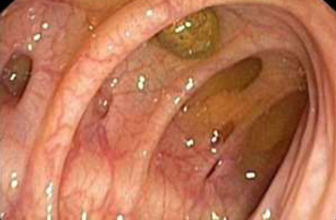 diverticular