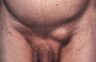 hernia