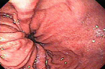 hernia